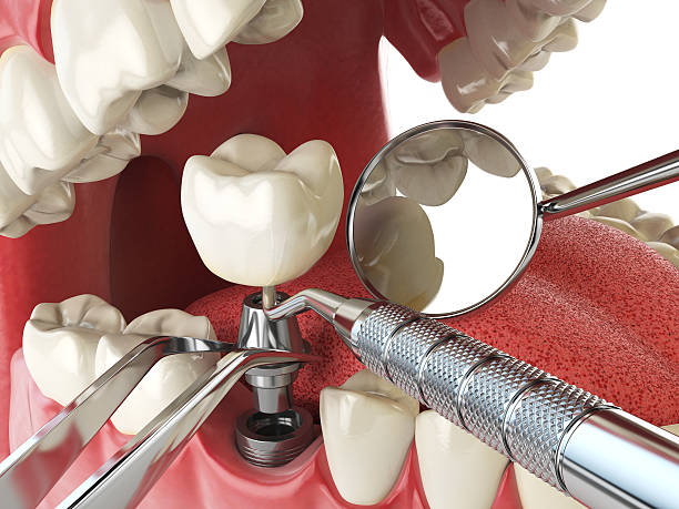 Best Emergency Wisdom Teeth Removal in Ocala Estates, FL